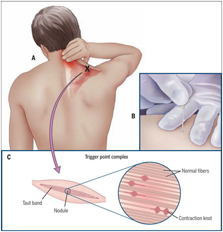 Trigger point nodule is targeted with the acupuncture needle during dry needling technique. 